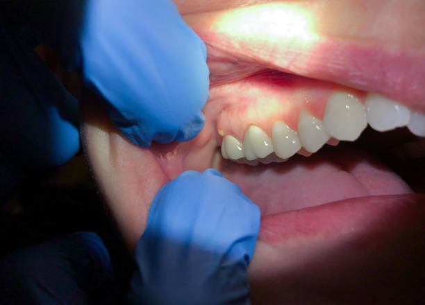 Best Emergency Treatment for Dental Infections or Abscesses in Rankin, PA